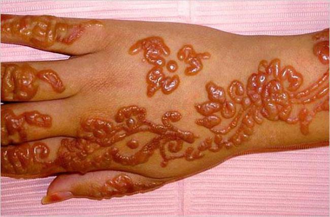 Последствия неправильно подобранного средства для удаления мехенди